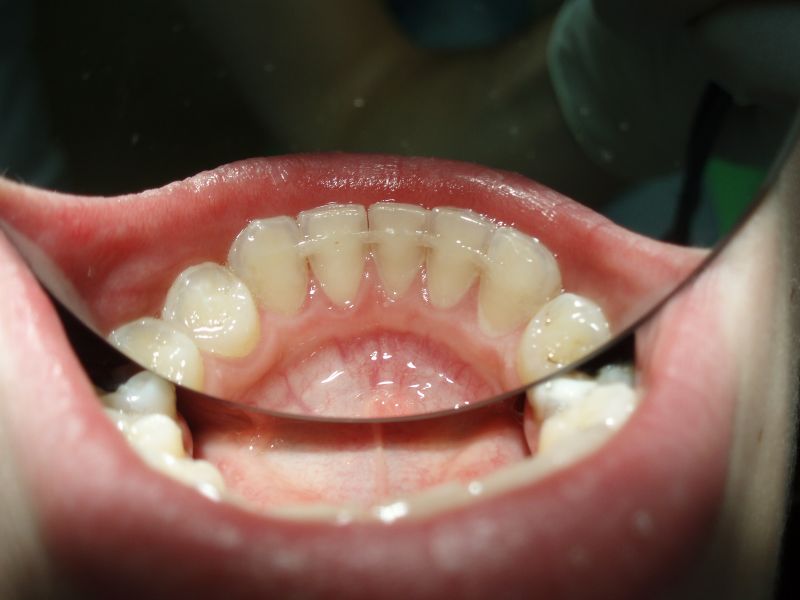 1. Post-ortodontický retainer; se svolením Dr. Fillipi, ČR