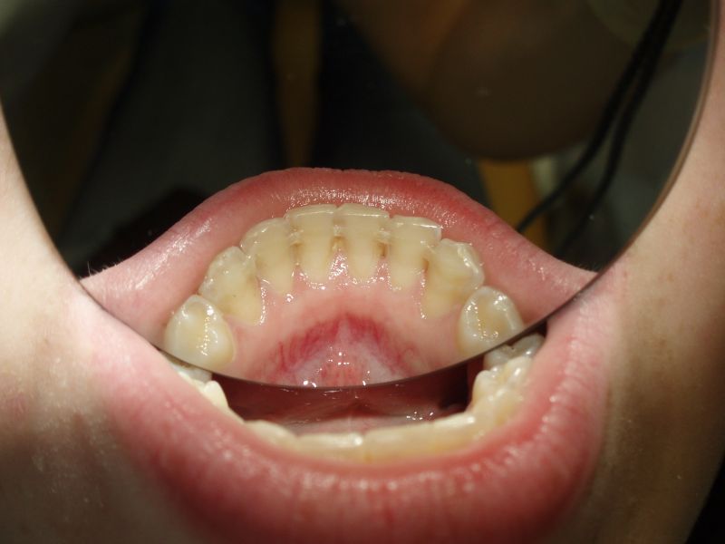 3. Post-ortodontický retainer; se svolením Dr. Fillipi, ČR